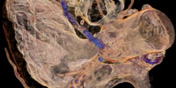 Prevenire i rischi dell’infarto: a Messina arriva un nuovo finanziamento