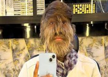 Lalit Patidar, l’uomo con più peli nel capo: quanti ne ha?